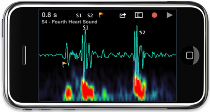 Stethoscope App: trasforma l’iPhone in uno stetoscopio