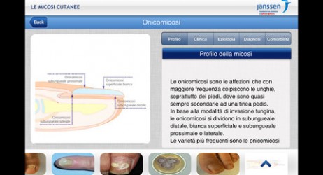 “Micosi cutanee”: la nuova App di Janssen a supporto dei medici nella gestione clinica delle dermatomicosi