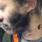 Scoppiano le cuffie Bluetooth, ferite al volto per una donna